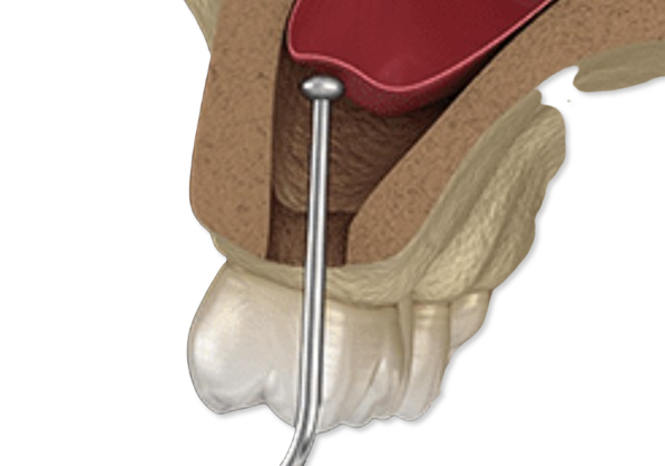 Sinus Lifting